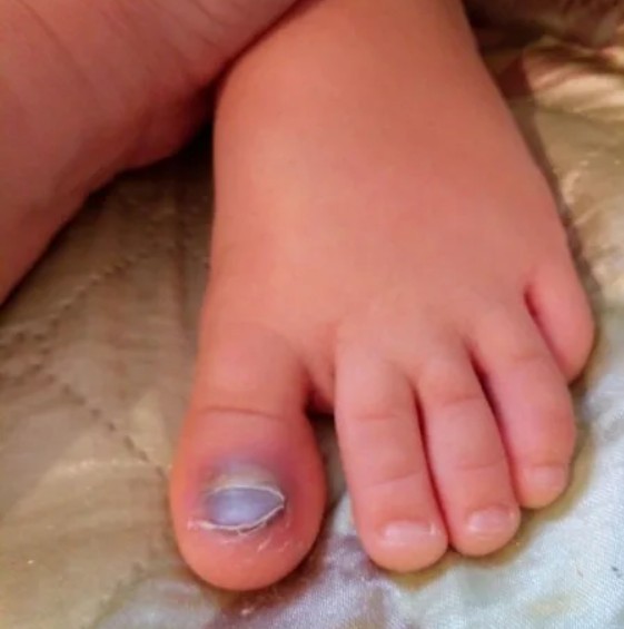 Травмы ногтя у ребенка
