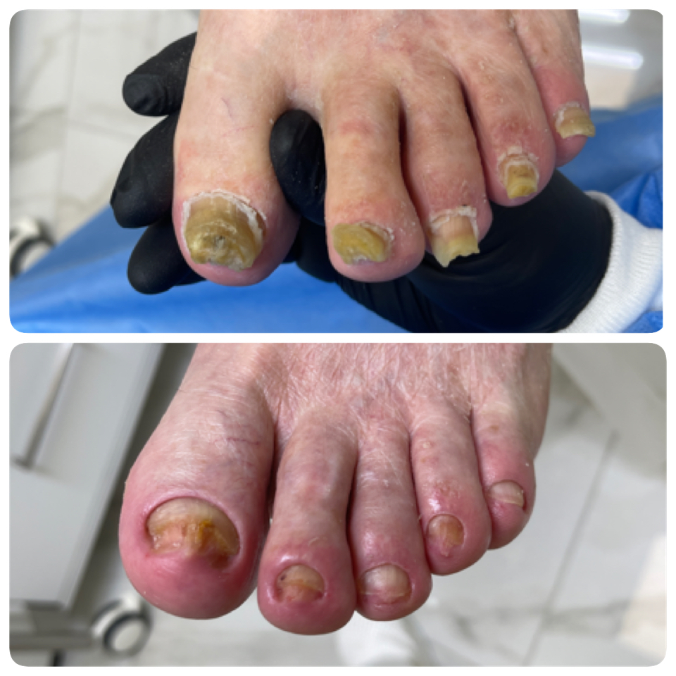 Чистка ногтей пораженных грибковой инфекцией