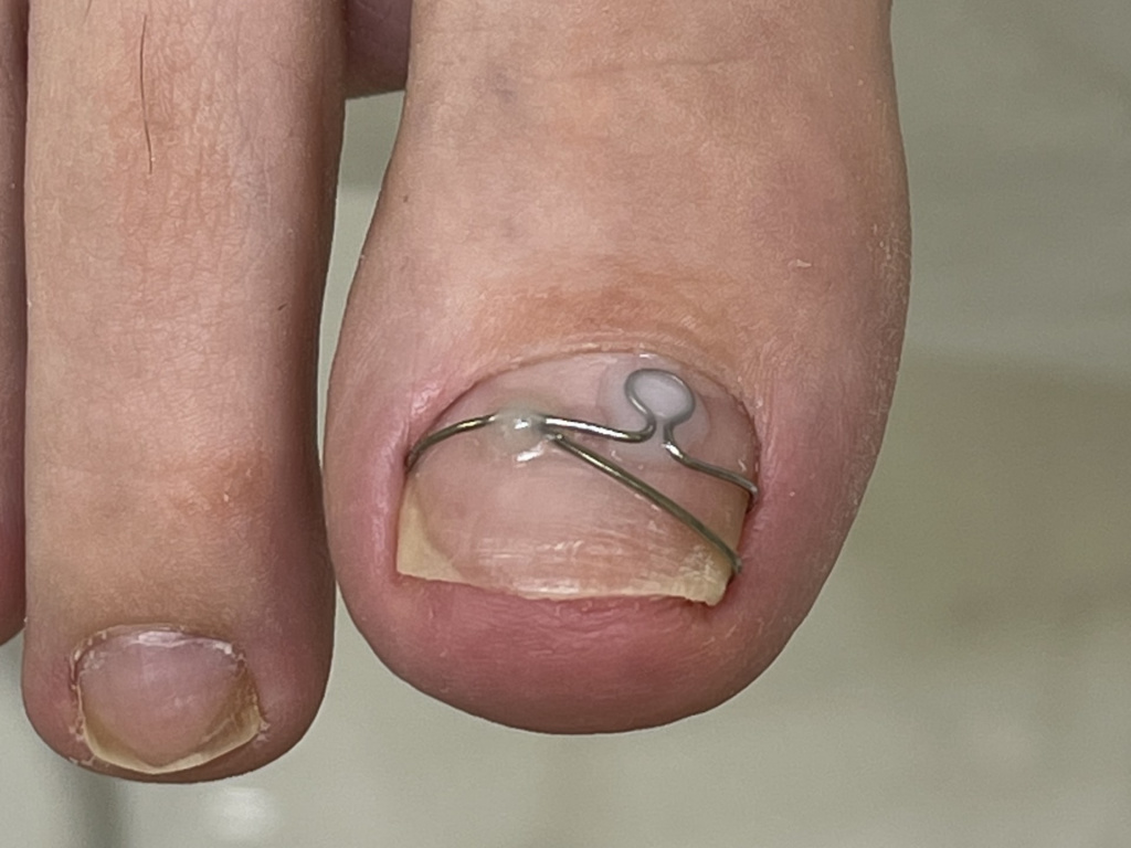 Скобы в лечении вросшего ногтя