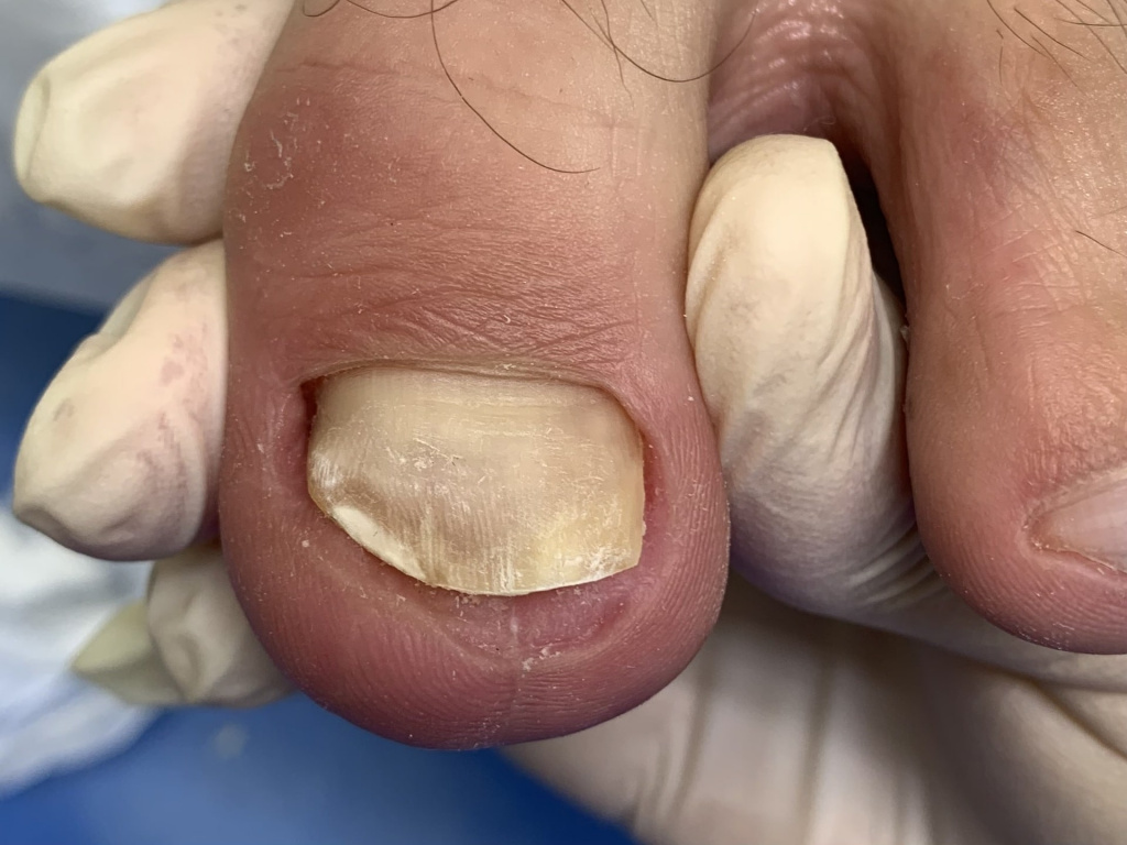 Воспаление ногтевого ложа: лечение, причины и диагностика воспаления
