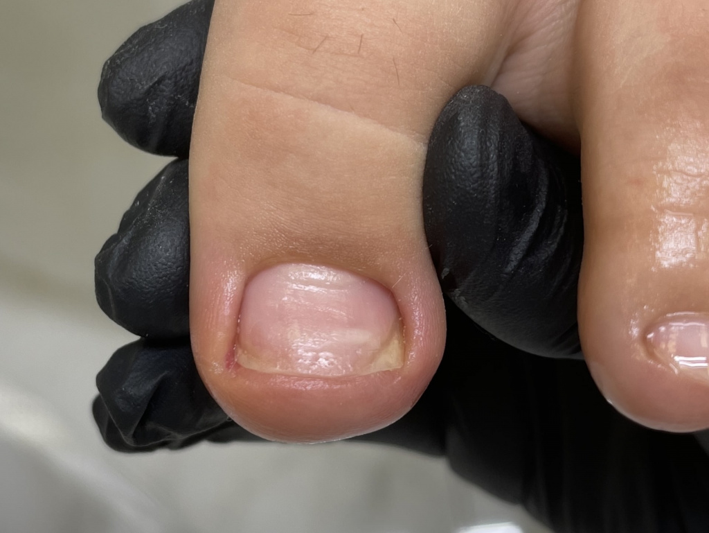Лечение вросшего ногтя | Титановая нить